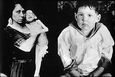 Leonhard Thomson vor und nach der Behandlung mit Insulin