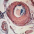 Cholesterin-Ablagerungen in einer Arterie - Foto: Uni Graz
