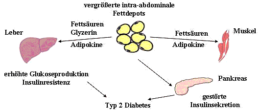 Intra-abdominale Adipositas und Pathophysiologie des Typ 2 Diabetes 