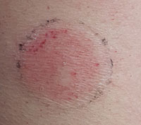 Hautprobleme bei Diabetes: Hautreaktionen auf Pflasterklebstoffe von Glukosesensoren.