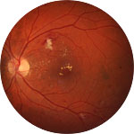 Fundusaufnahme für Netzhaut-Screening mittels KI. Fundusaufnahme für Netzhaut-Screening mittels KI.